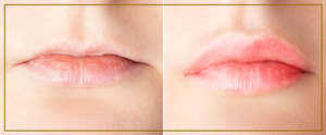 Lip Filler Specialist Near Me in Miami, FL Lip Filler Specialist Near Me in Miami, FL